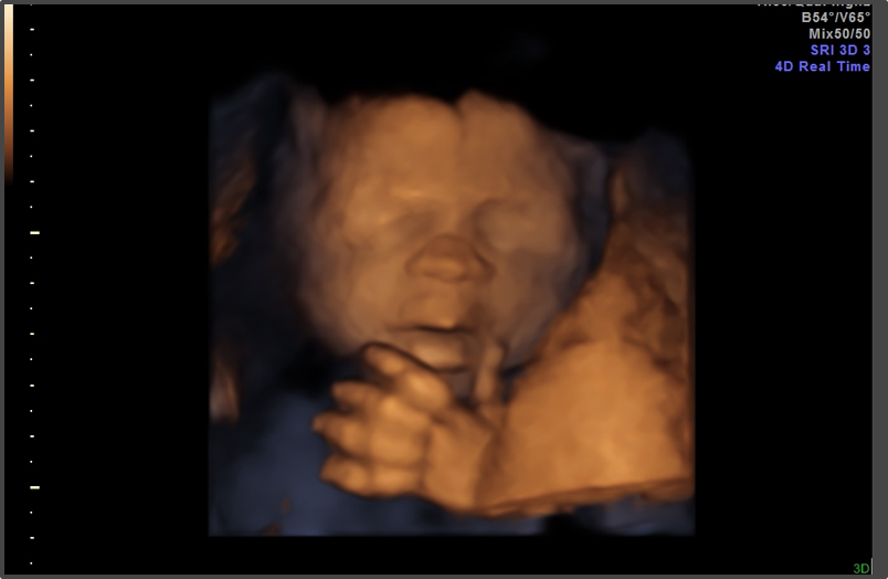 weeks week pregnancy ultrasound fetus 3d abortion gestation pain would during days horrifying procedure abortive sues experienced discovering mother babies