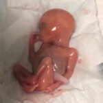 baby-samuel-aborted-australia-sucking-thumb